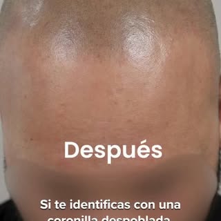 Si te identificas con una coronilla despoblada, la micropigmentación capilar puede ser una solución 