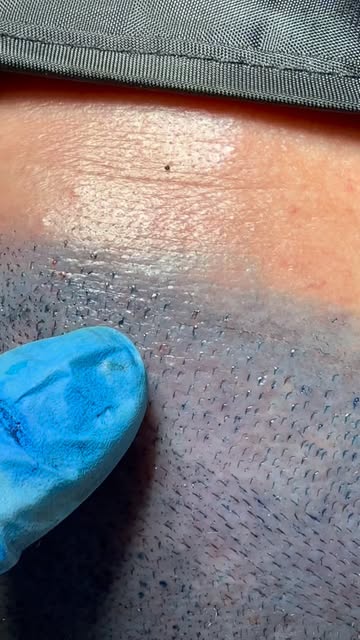 🥇PADRÃO OURO🥇 A importância das macro e micro irregularidades na Hair Line no transplante capilar.