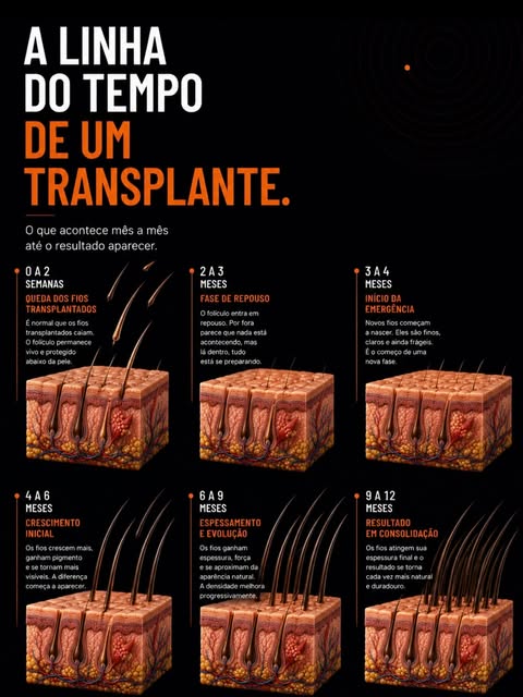 O transplante capilar não termina quando o procedimento termina.

Existe um processo de transformaçã