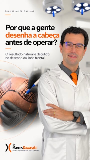 O resultado de um transplante capilar começa muito antes da cirurgia.

A linha frontal não deve ser 