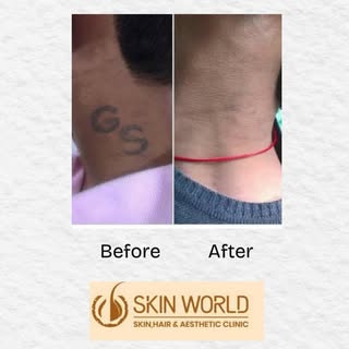 #tattooremoval #notattoos #skindoctor #healthyskin #clearskin #skincare #skin #skinclinicbilaspur #c