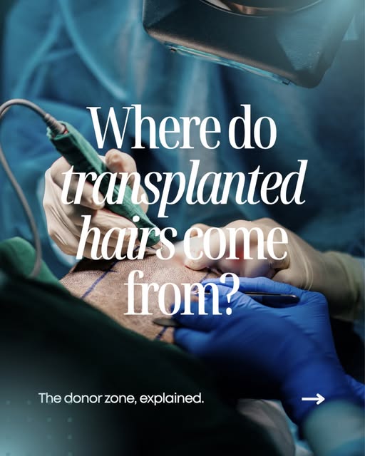 Ever wondered where the magic happens in a hair transplant? 🪄 It’s all about the donor zone!

Trans