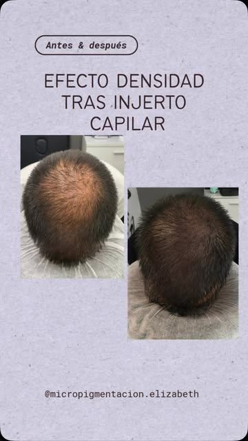 ¿Te has hecho un injerto y todavía tienes zonas con poca densidad? No lo dudes y pide tu presupuesto