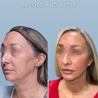 We almost cancelled. 𝕋𝕨𝕚𝕔𝕖.
Glad we didn’t.
Full facial rejuvenation: brow reset, eyelift, baby