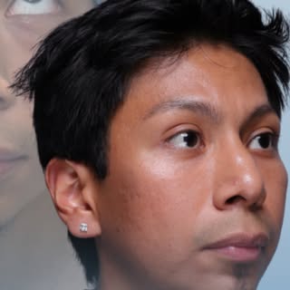 🗣️ Your eyes say a lot before you even speak.

For this patient, fullness under the eyes gave off a