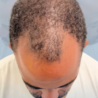 🗓️ The true test of a hair transplant isn’t what it looks like after a few months. It’s what it loo