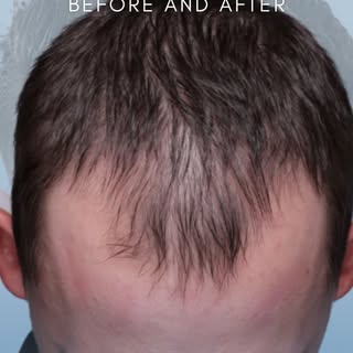 🗣️ Sometimes the biggest change isn’t adding more hair, it’s restoring the right hairline.

This pa