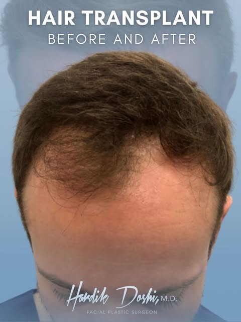 🗣️ The most refined hair restoration is the kind that doesn’t look overdone.

This patient wanted t