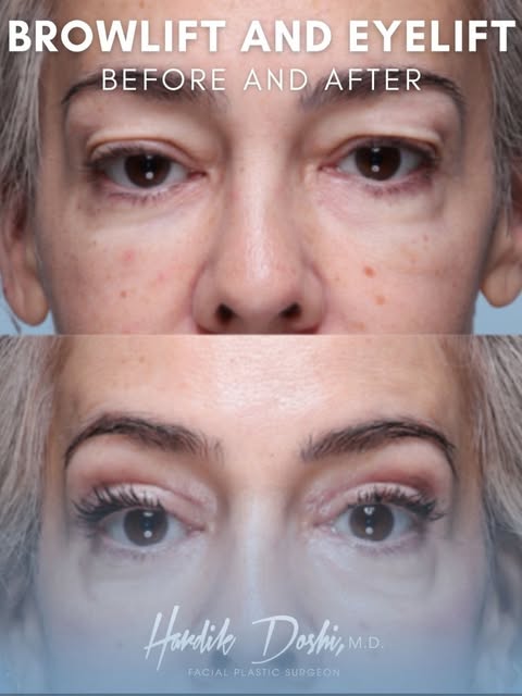 🗣️ Sometimes the eyes are not the only reason the upper face looks tired.

As the brows descend and