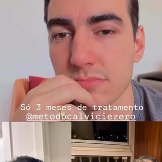 Contra fatos, não há argumentos.
Resultados reais. Pacientes reais.

Método Calvície Zero — referênc