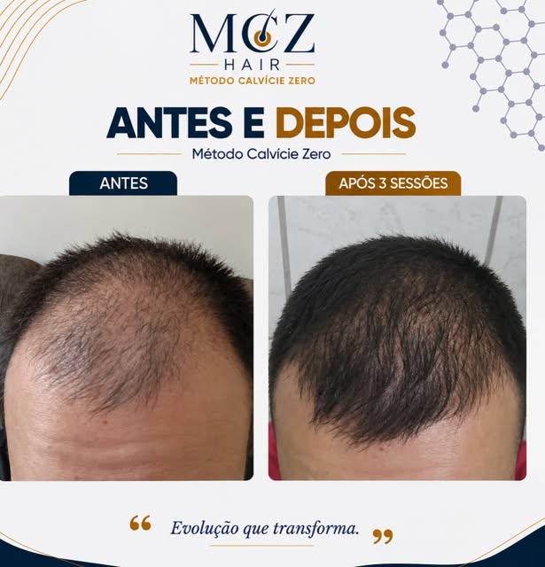 Olha essa evolução após apenas 3 sessões do Método Calvície Zero. 🚀

Mais cobertura, melhora visual
