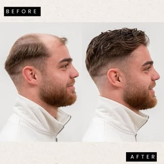 Book your free consultation and get your new hair system! 💇‍♂️ #lucapiattellidubai #hairfixing #hai
