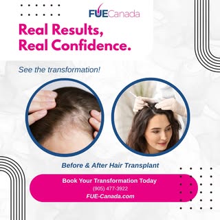 Real results, real confidence. Our hair transplant procedures are designed to restore a fuller, more