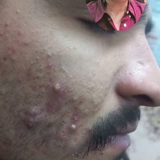 Acne treatment by world's renowned dermatologist Dr Syed Bilal Shams Associate Professor of Dermatol