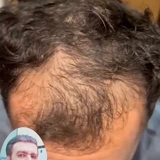 Hairfall treatment with exosomes by world's renowned dermatologist Dr Syed Bilal Shams Associate Pro