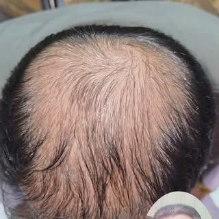 Hairfall treatment with exosomes by world's renowned dermatologist Dr Syed Bilal Shams Associate Pro