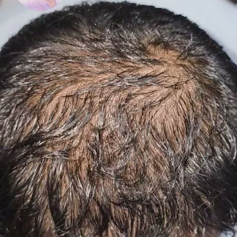 Combination approach 
Results of Exosomes by world's renowned dermatologist Dr Syed Bilal Shams Asso