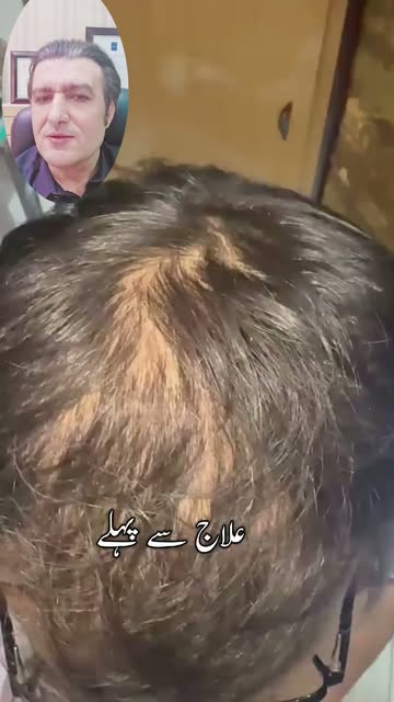Hair growth after Exosomes by world's renowned dermatologist Dr Syed Bilal Shams 
#exosome #drbilals