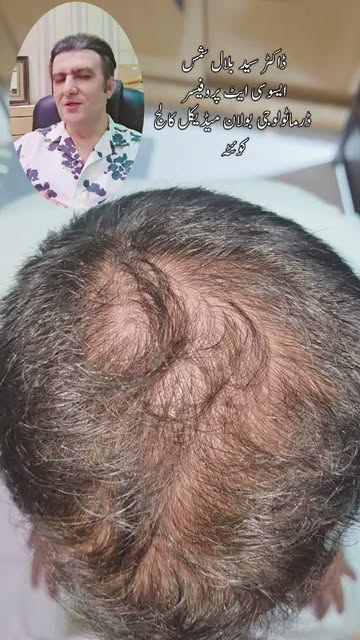 Hair regrowth without hair transplantation by world's renowned dermatologist Dr Syed Bilal Shams 
#d