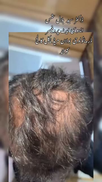 Hair growth with exosomes by world's renowned dermatologist Dr Syed Bilal Shams Associate Professor 