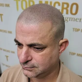 Soft-natural hairline design with Scalp Micropigmentation 
.
Contact us for a free consultation
.
#t