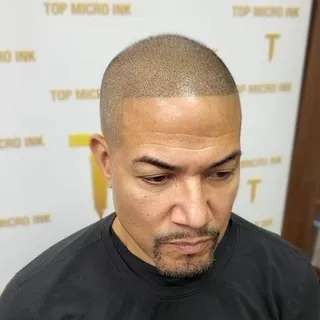 Scalpmicropigmentation procedure is right choice when presenting hairloss, thinning hair or scars. S