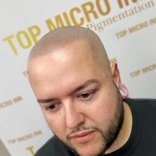 Smp is a highly effective non-invasive method for individuals presenting hair loss.
You will start s