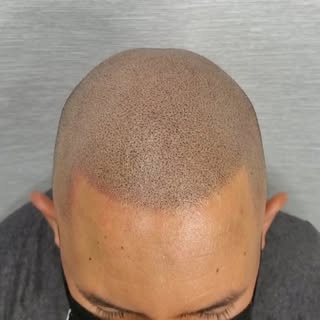 Scalp Micro Pigmentation results
.
Contact us for a consultation
.
#smp #hairtattoo #smpnj #hairloss