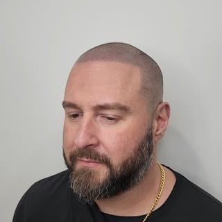 Scalp Micro Pigmentation cover all the range of types hair loss: Balding, Thinning hair, Alopecia an