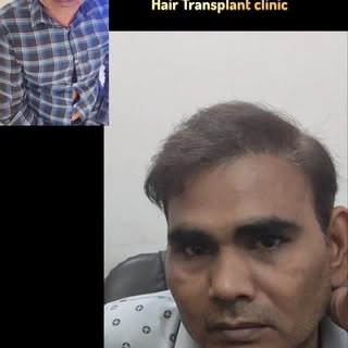 5 star Rating review patient 
100% natural result 
100% satisfied patient 
Call us for Hair Transpla