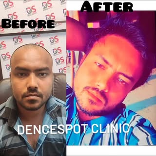 Hair Transplant final result 
,📞8178330800

#hairtransformation #hairgrowth #hairtransplant #hairfa