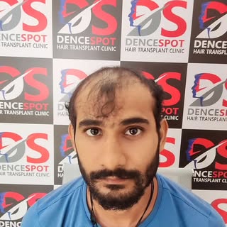 Hair Transplant 
Call 8178330800
Hairline transplant is the term doctors use to describe a hair tran