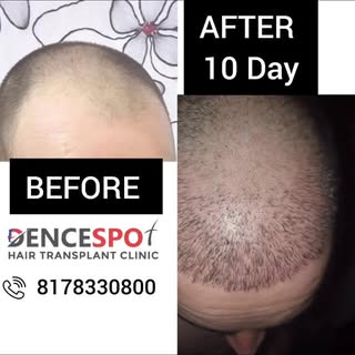 Hairline reconstruction is a surgical approach that helps in improving the appearance of the frontal