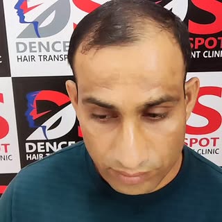 Hair transplant done implanted 4893 Grafts
📞8178330800 for more information 
For such videos please