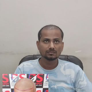 Hair Transplant result after 1 month.
Amazing result 
Call on  8178330800
Follow us for such videos 