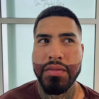 El injerto de barba y cabellera son actualmente las cirugías que más se realizan en 🇲🇽 México
