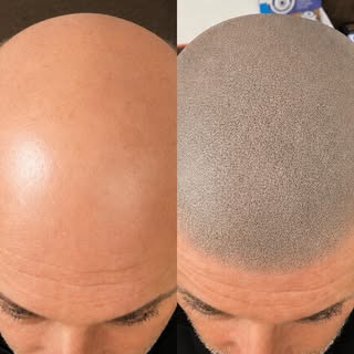 Elevate your confidence with Scalp Micropigmentation (SMP / Hair Tattoo) for baldness, thinning hair