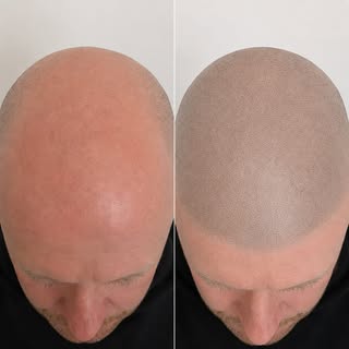 Elevate your confidence with Scalp Micropigmentation (SMP / Hair Tattoo) for baldness, thinning hair