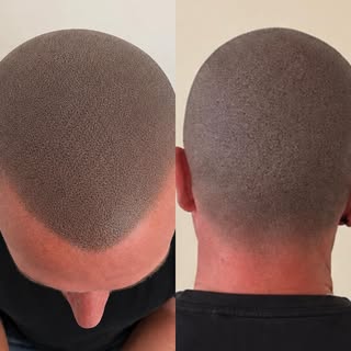 Top-up time for this client. SMP should last 3 to 5 years and then you get it topped up in a single 