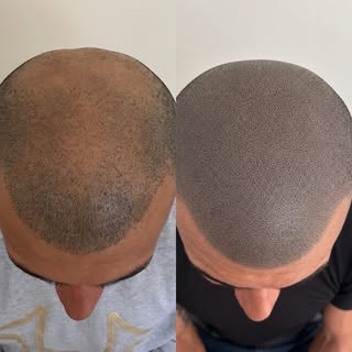 Elevate your confidence with Scalp Micropigmentation (SMP / Hair Tattoo) for baldness, thinning hair