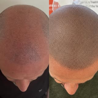 Elevate your confidence with Scalp Micropigmentation (SMP / Hair Tattoo) for baldness, thinning hair