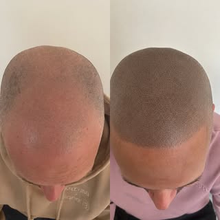 Elevate your confidence with Scalp Micropigmentation (SMP / Hair Tattoo) for baldness, thinning hair