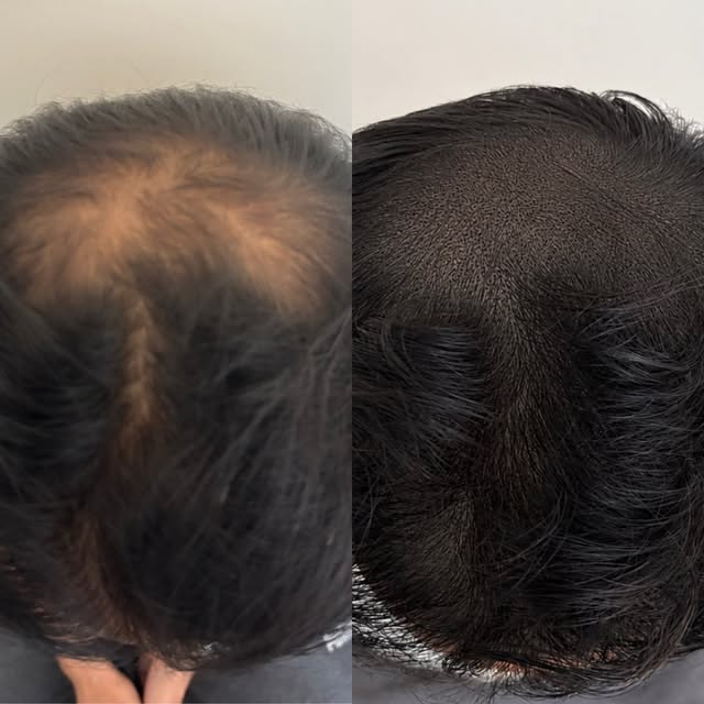 Added density to a thinning crown using SMP. 

Elevate your confidence with Scalp Micropigmentation 