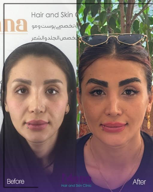 اگه از فرم یا کم‌پشتی ابروهات راضی نیستی، شاید وقتشه یه تغییر موندگارتر رو بررسی کنی 🌱

در کاشت ابر
