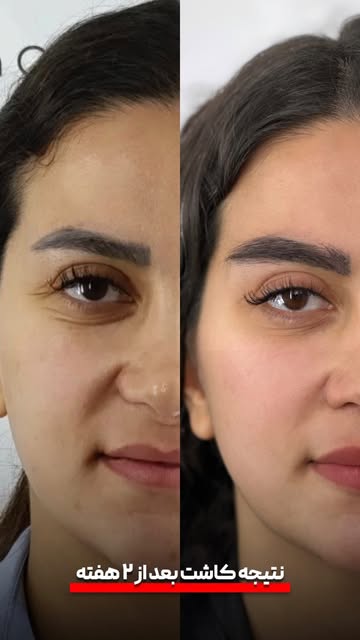 ⁨	همه‌چی از یه تصمیم کوچیک شروع میشه… ✨
تصمیمی برای داشتن ابروهایی پرتر، قرینه‌تر و متناسب با چهره‌ا
