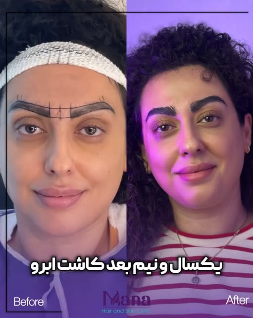 چرا کاشت ابرو کلینیک مانا!؟
🔺رکورددار #کاشت_ابرو در خراسان
🔺مجهز به اتاقهای کاشت vip
با مدیریت:#دک