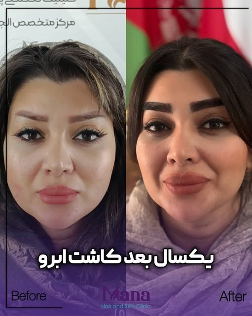 یک تغییر توی ابروهات، می‌تونه کل چهره‌تو عوض کنه! ✨

در کاشت ابرو، طراحی بر اساس فرم صورت و سلیقه خو