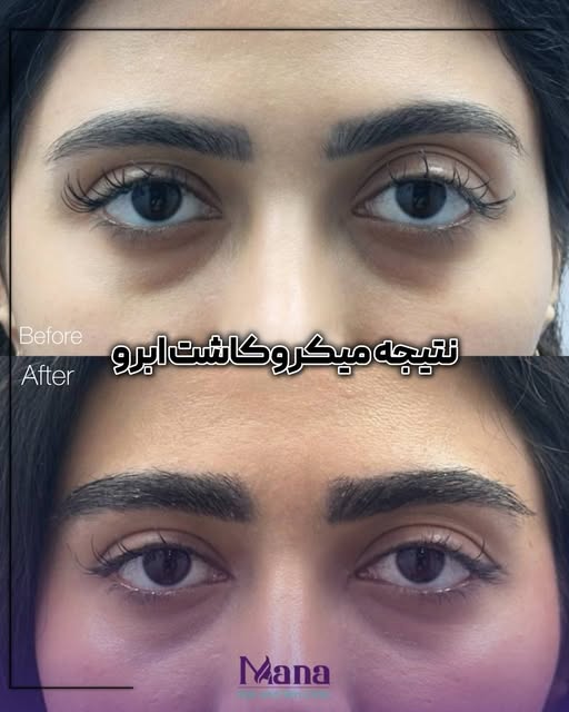 ابروهای کم‌پشت، خالی یا نامتقارن دیگه قرار نیست اعتمادبه‌نفست رو کم کنن. 🤍

با کاشت ابرو می‌تونی به