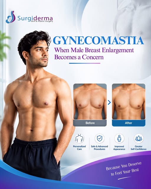 Gynecomastia (male breast enlargement) is a common condition caused by hormonal imbalances, weight f