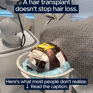 Hair loss doesn't stop after surgery.

A hair transplant restores the areas that have already thinne